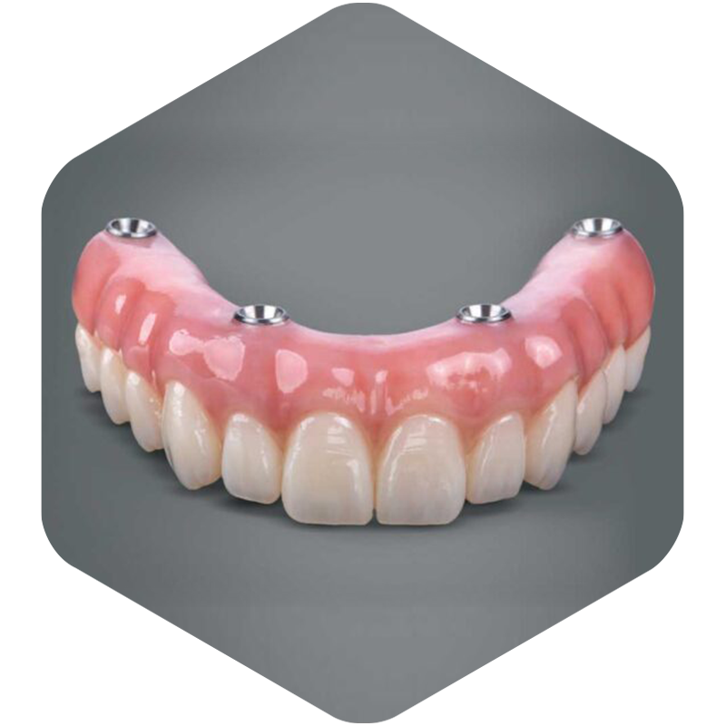 illustration of implant supported dentures